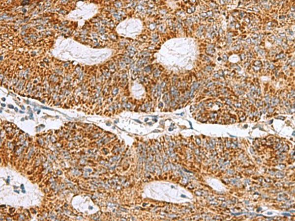 Immunohistochemistry of paraffin-embedded Human colorectal cancer tissue  using MRPS28 Polyclonal Antibody at dilution of 1:105(?200)