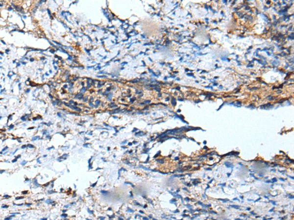 Immunohistochemistry of paraffin-embedded Human cervical cancer tissue  using DEFB104A Polyclonal Antibody at dilution of 1:50(?200)