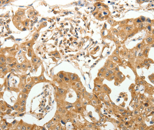 Immunohistochemistry of paraffin-embedded Human lung cancer tissue using MAP1B  Polyclonal Antibody at dilution 1:40