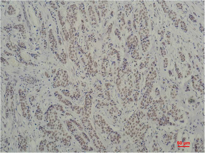 Immunohistochemistry of paraffin-embedded Human breast carcinoma tissue using TBP Monoclonal Antibody at dilution of 1:200.