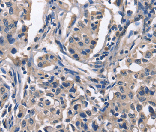 Immunohistochemistry of paraffin-embedded Human lung cancer using PEBP1 Polyclonal Antibody at dilution of 1:50