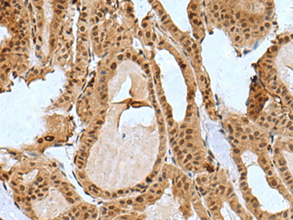 Immunohistochemistry of paraffin-embedded Human thyroid cancer tissue  using BCL7B Polyclonal Antibody at dilution of 1:85(?200)