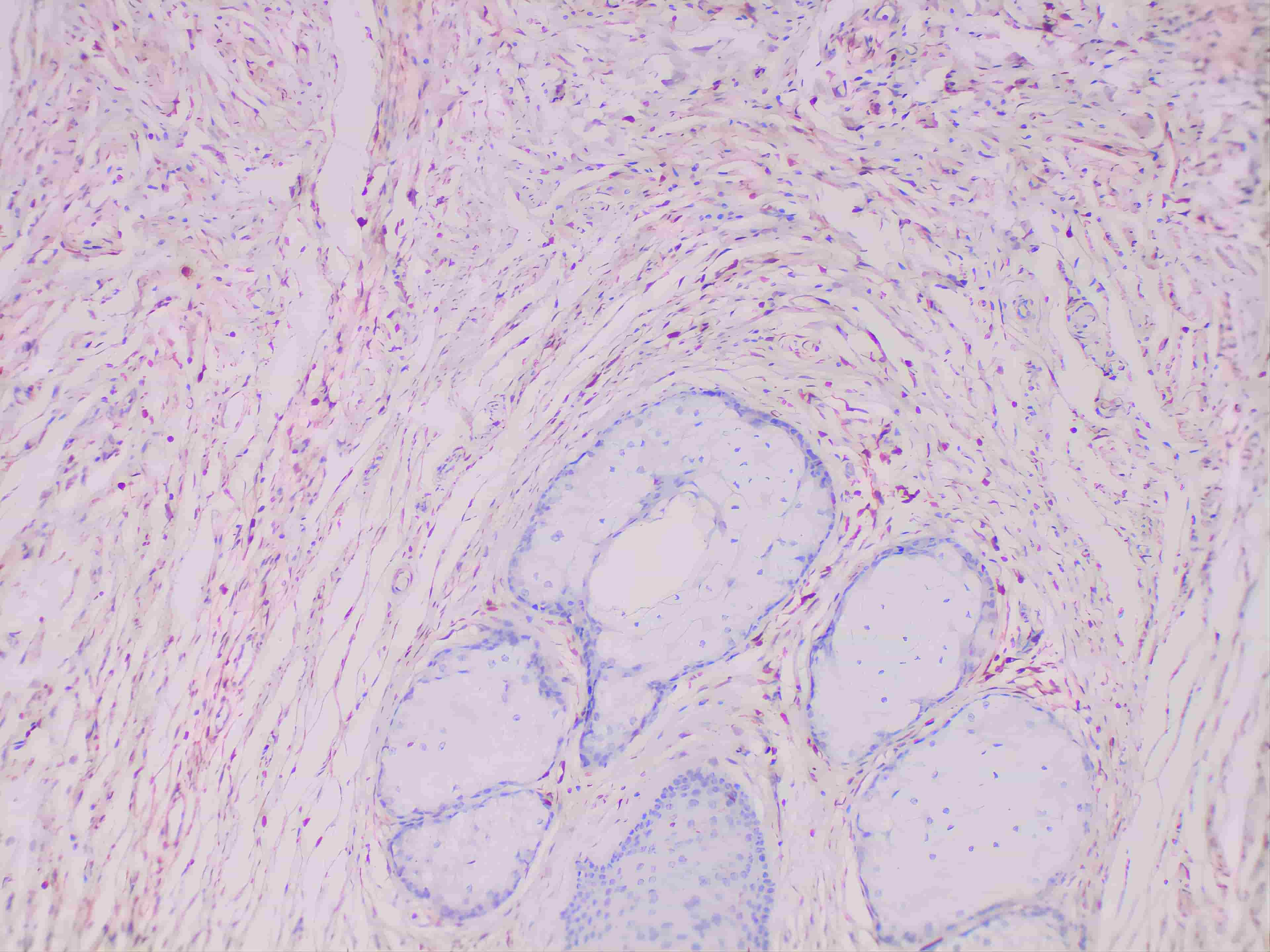 Immunohistochemistry of paraffinembedded Human melanoma tissue with S100A4 Monoclonal Antibody(Antigen repaired by EDTA).