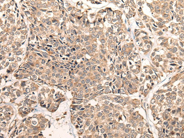 Immunohistochemistry of paraffin-embedded Human esophagus cancer tissue  using LDAH Polyclonal Antibody at dilution of 1:55(?200)