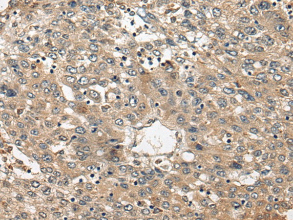 Immunohistochemistry of paraffin-embedded Human liver cancer tissue  using FUT4 Polyclonal Antibody at dilution of 1:40(?200)