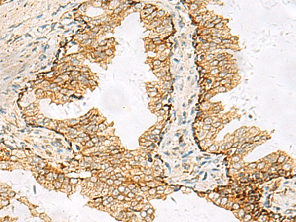 Immunohistochemistry of paraffin-embedded Human prost at e cancer tissue  using SH3YL1 Polyclonal Antibody at dilution of 1:55(?200)