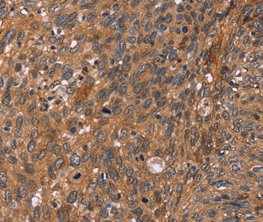 Immunohistochemistry of paraffin-embedded Human cervical cancer using APAF1 Polyclonal Antibody at dilution of 1:40