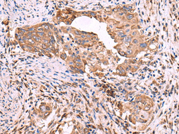 Immunohistochemistry of paraffin-embedded Human cervical cancer tissue  using EEF1D Polyclonal Antibody at dilution of 1:55(?200)