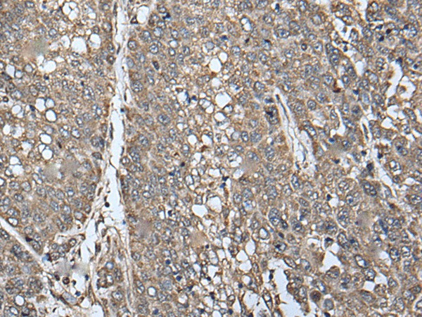 Immunohistochemistry of paraffin-embedded Human liver cancer tissue  using ATAD1 Polyclonal Antibody at dilution of 1:65(?200)