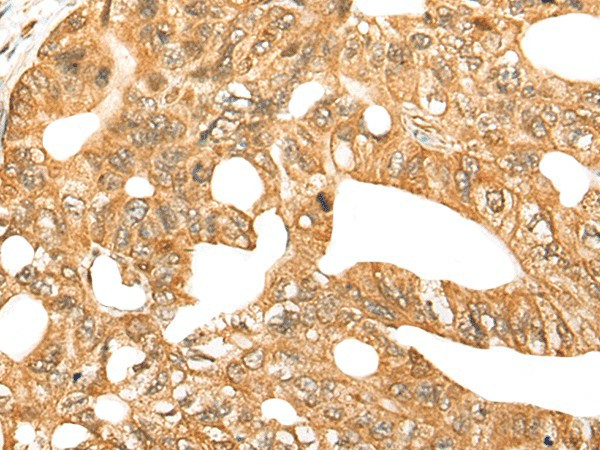 Immunohistochemistry of paraffin-embedded Human gastric cancer tissue  using CDCA4 Polyclonal Antibody at dilution of 1:70(?200)