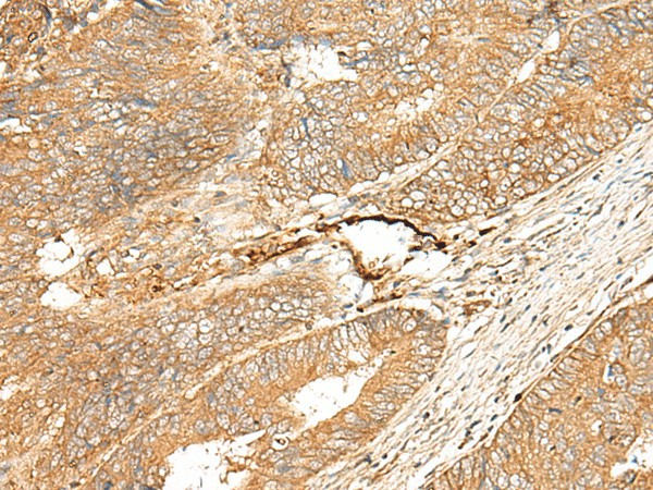 Immunohistochemistry of paraffin-embedded Human colorectal cancer tissue  using ADGRF5 Polyclonal Antibody at dilution of 1:40(?200)