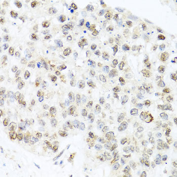 Immunohistochemistry of paraffin-embedded Human lung cancer using CETN3 Polyclonal Antibody at dilution of  1:100 (40x lens).