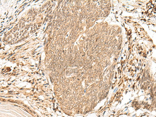 Immunohistochemistry of paraffin-embedded Human esophagus cancer tissue  using VPS50 Polyclonal Antibody at dilution of 1:45(?200)