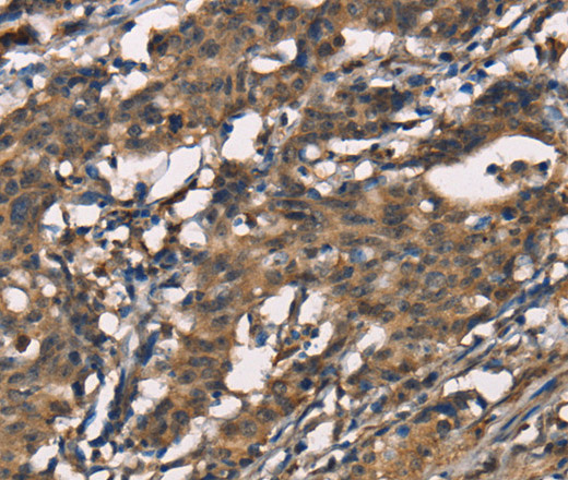 Immunohistochemistry of paraffin-embedded Human gastic cancer using SENP1 Polyclonal Antibody at dilution of 1:40