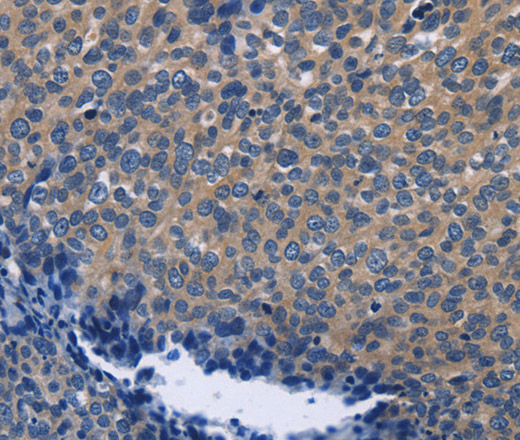 Immunohistochemistry of paraffin-embedded Human cervical cancer using SYT17 Polyclonal Antibody at dilution of 1:60