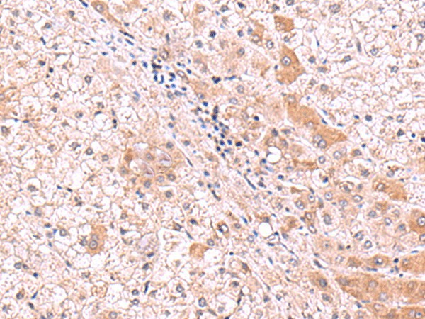 Immunohistochemistry of paraffin-embedded Human liver cancer tissue  using RIC8A Polyclonal Antibody at dilution of 1:80(?200)