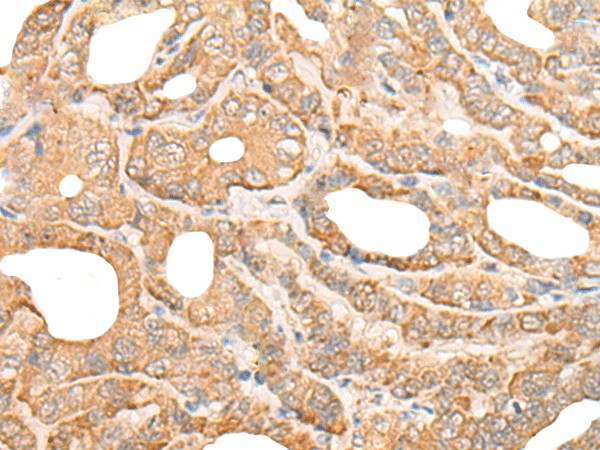 Immunohistochemistry of paraffin-embedded Human thyroid cancer tissue  using DEF8 Polyclonal Antibody at dilution of 1:25(?200)