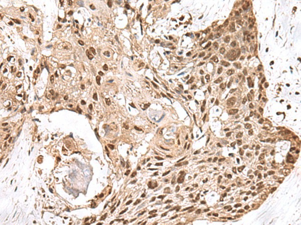 Immunohistochemistry of paraffin-embedded Human esophagus cancer tissue  using MAGOHB Polyclonal Antibody at dilution of 1:70(?200)