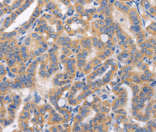 Immunohistochemistry of paraffin-embedded Human thyroid cancer tissue using CARD17 Polyclonal Antibody at dilution 1:50