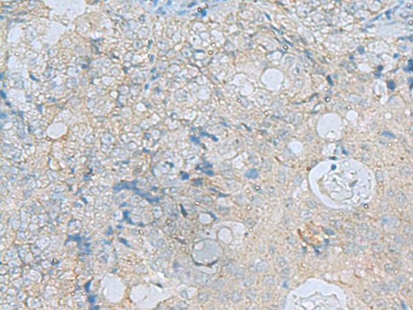 Immunohistochemistry of paraffin-embedded Human ovarian cancer tissue  using ENKD1 Polyclonal Antibody at dilution of 1:75(?200)