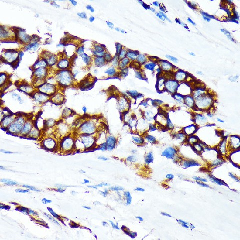 Immunohistochemistry of paraffin-embedded human lung cancer using KRT36 Polyclonal Antibody at dilution of 1:100 (40x lens).Perform microwave antigen retrieval with 10 mM Tris/EDTA buffer pH 9.0 before commencing with IHC staining protocol.