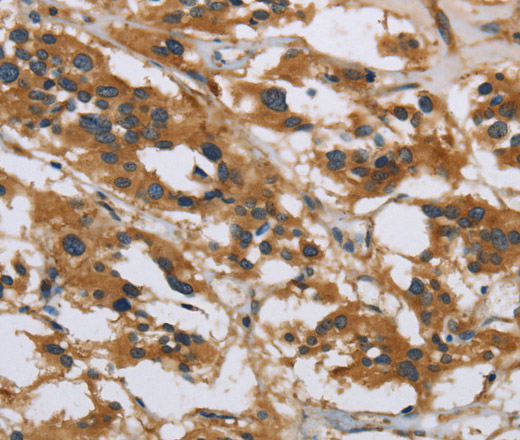 Immunohistochemistry of paraffin-embedded Human thyroid cancer using IL5RA Polyclonal Antibody at dilution of 1:40