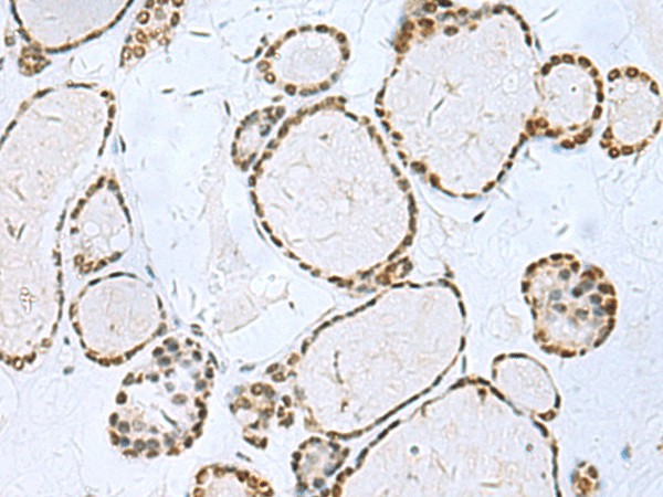 Immunohistochemistry of paraffin-embedded Human thyroid cancer tissue  using TH Polyclonal Antibody at dilution of 1:40(?200)