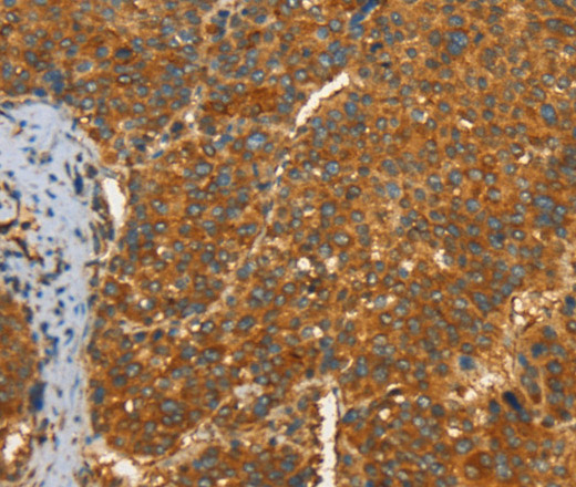 Immunohistochemistry of paraffin-embedded Human liver cancer tissue using PFKFB1 Polyclonal Antibody at dilution 1:60