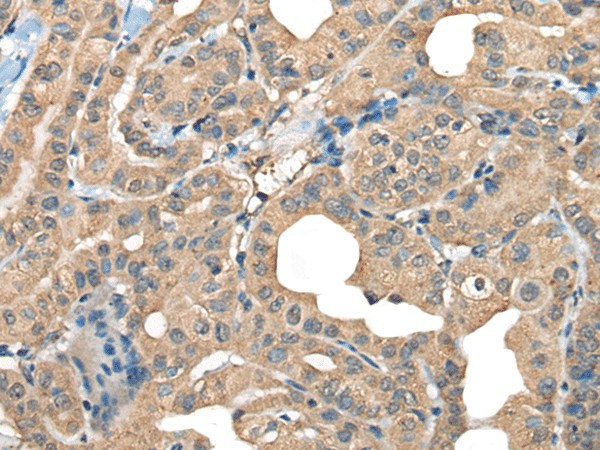 Immunohistochemistry of paraffin-embedded Human thyroid cancer tissue  using CABP5 Polyclonal Antibody at dilution of 1:65(?200)