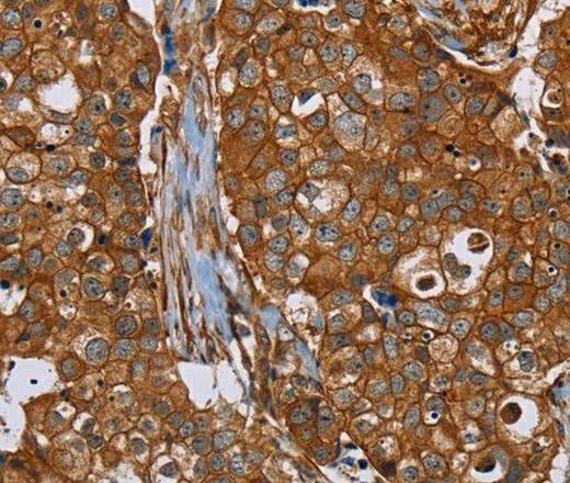 Immunohistochemistry of paraffin-embedded Human breast cancer tissue using PLEC Polyclonal Antibody at dilution 1:40