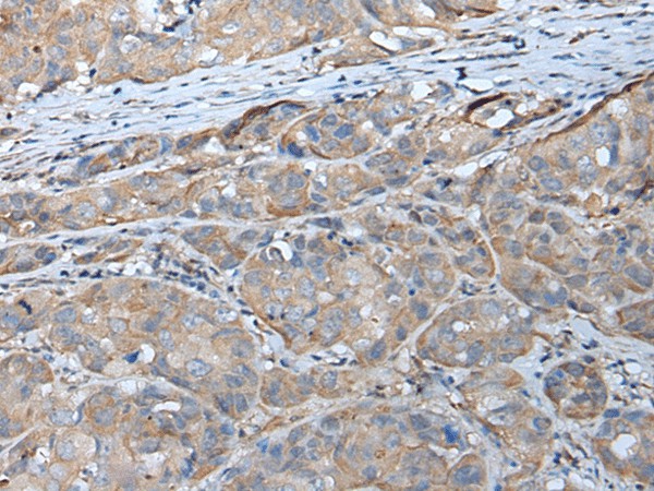 Immunohistochemistry of paraffin-embedded Human breast cancer tissue  using GPC5 Polyclonal Antibody at dilution of 1:40(?200)