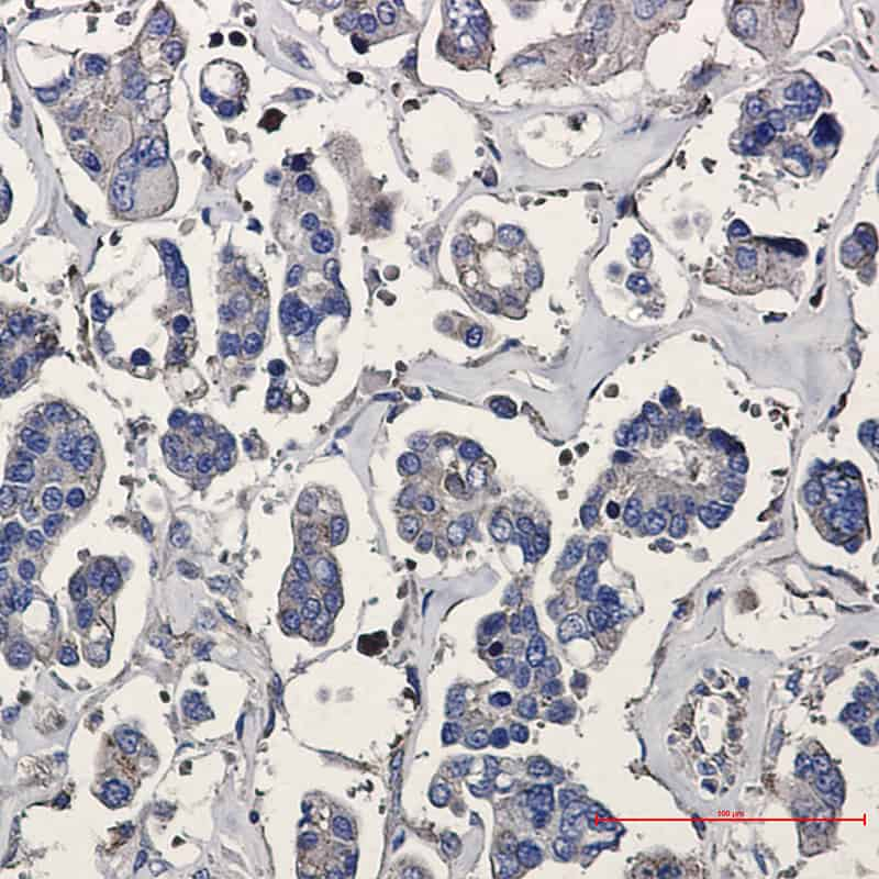 Immunohistochemistry of p16 ARC in paraffin-embedded Human Cholangiocarcinoma using p16 ARC Rabbit mAb at dilution 1/20