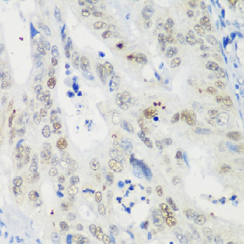 Immunohistochemistry of paraffin-embedded Human colon carcinoma using p53 Polyclonal Antibody at dilution of  1:200 (40x lens).