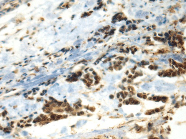 Immunohistochemistry of paraffin-embedded Human breast cancer tissue  using DDX39A Polyclonal Antibody at dilution of 1:70(?200)