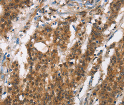 Immunohistochemistry of paraffin-embedded Human gastic cancer using BCAS4 Polyclonal Antibody at dilution of 1:50