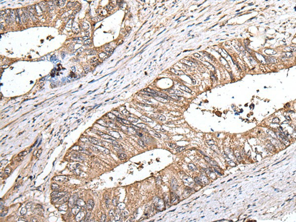 Immunohistochemistry of paraffin-embedded Human colorectal cancer tissue  using ZNHIT1 Polyclonal Antibody at dilution of 1:40(?200)