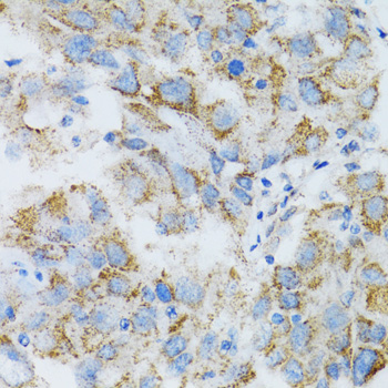 Immunohistochemistry of paraffin-embedded Human breast cancer using PSMD10 Polyclonal Antibody at dilution of 1:100 (40x lens).