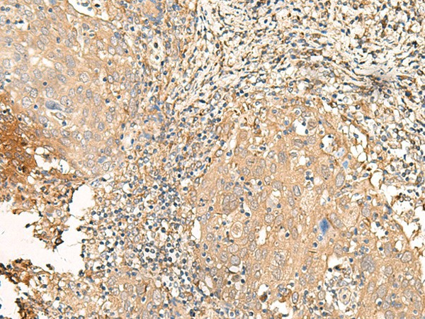 Immunohistochemistry of paraffin-embedded Human cervical cancer tissue  using GALR2 Polyclonal Antibody at dilution of 1:25(?200)