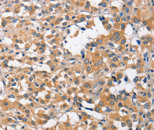 Immunohistochemistry of paraffin-embedded Human thyroid cancer tissue using CCL4 Polyclonal Antibody at dilution 1:40