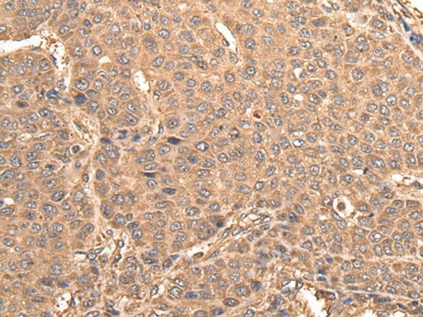 Immunohistochemistry of paraffin-embedded Human liver cancer tissue  using BUD31 Polyclonal Antibody at dilution of 1:75(?200)