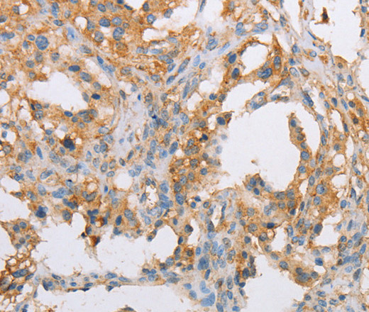 Immunohistochemistry of paraffin-embedded Human thyroid cancer tissue using ACTR2 Polyclonal Antibody at dilution 1:40