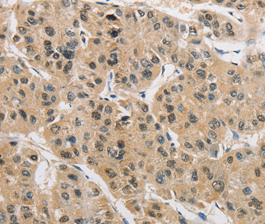 Immunohistochemistry of paraffin-embedded Human liver cancer tissue using AMZ2 Polyclonal Antibody at dilution 1:40