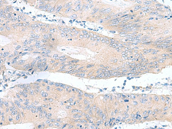 Immunohistochemistry of paraffin-embedded Human colorectal cancer tissue  using RPS16 Polyclonal Antibody at dilution of 1:65(?200)