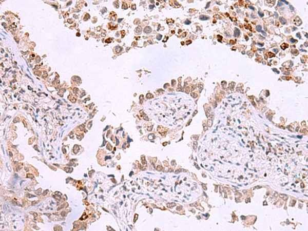 Immunohistochemistry of paraffin-embedded Human lung cancer tissue  using ITPKC Polyclonal Antibody at dilution of 1:30(?200)