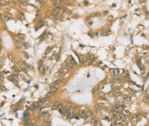 Immunohistochemistry of paraffin-embedded Human colon cancer tissue using SIGLEC15 Polyclonal Antibody at dilution 1:35