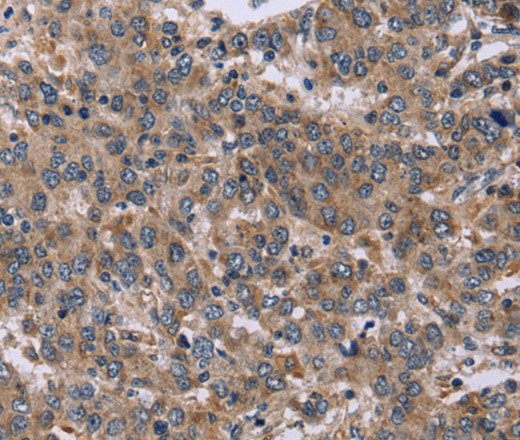 Immunohistochemistry of paraffin-embedded Human liver cancer tissue using EDN3 Polyclonal Antibody at dilution 1:50