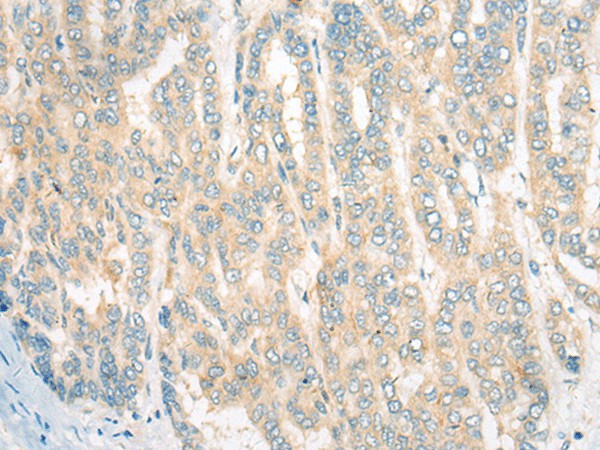 Immunohistochemistry of paraffin-embedded Human liver cancer tissue  using CDKAL1 Polyclonal Antibody at dilution of 1:60(?200)