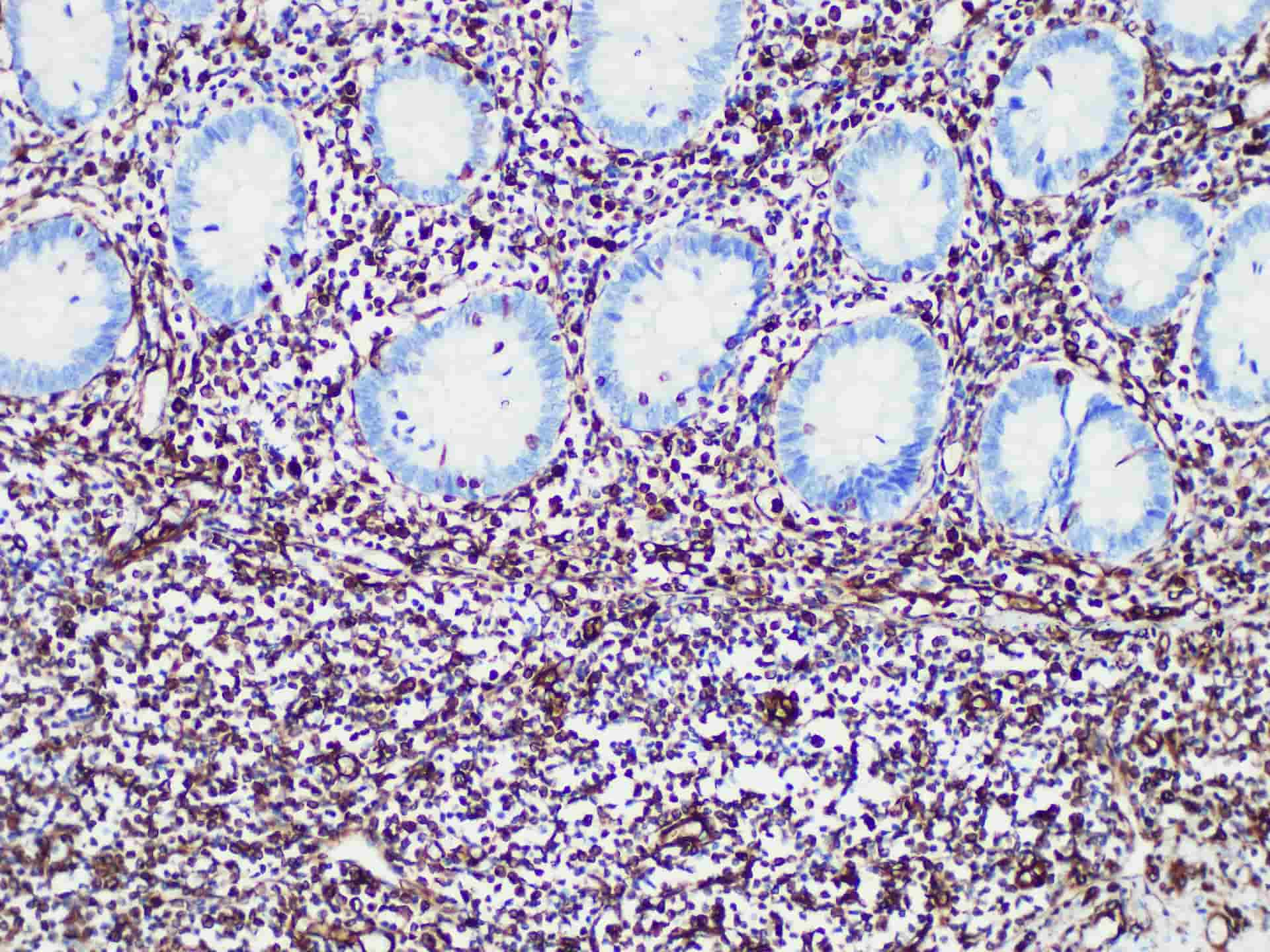 Immunohistochemistry of paraffinembedded Human liver tissue with Vimentin Monoclonal Antibody(Antigen repaired by EDTA).