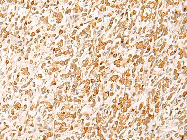 Immunohistochemistry of paraffin-embedded Human gastric cancer tissue  using HTT Polyclonal Antibody at dilution of 1:25(?200)