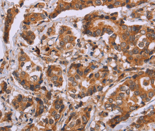 Immunohistochemistry of paraffin-embedded Human breast cancer tissue using CALCA Polyclonal Antibody at dilution 1:40